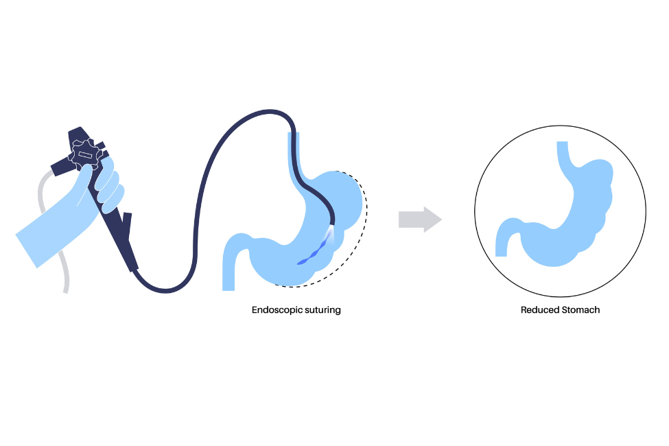 >Endoscopic Sleeve Gastroplasty (ESG)